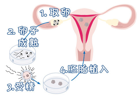代孕