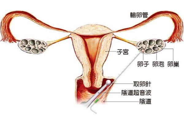 代孕