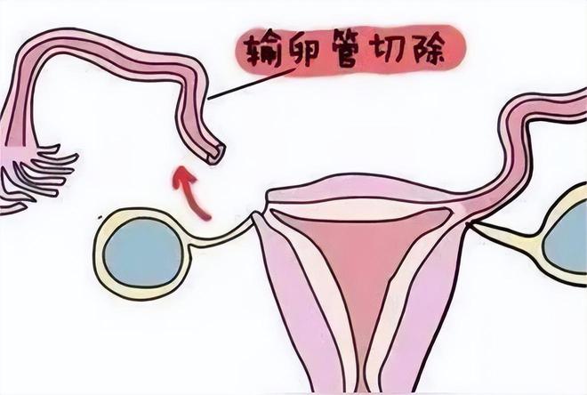 代孕