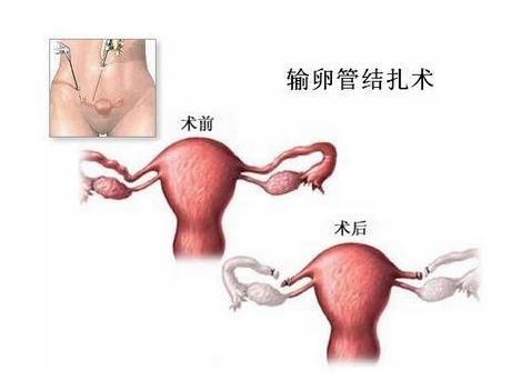 代孕产子