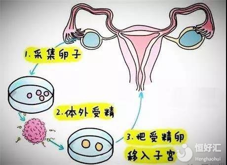 代孕